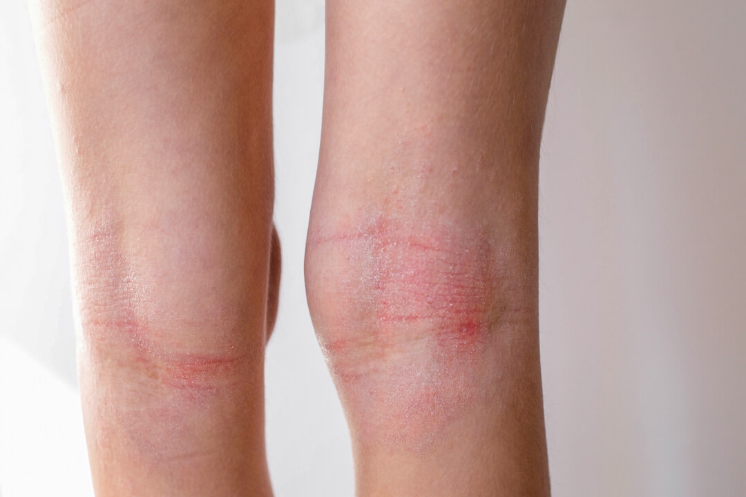 アトピー性皮膚炎