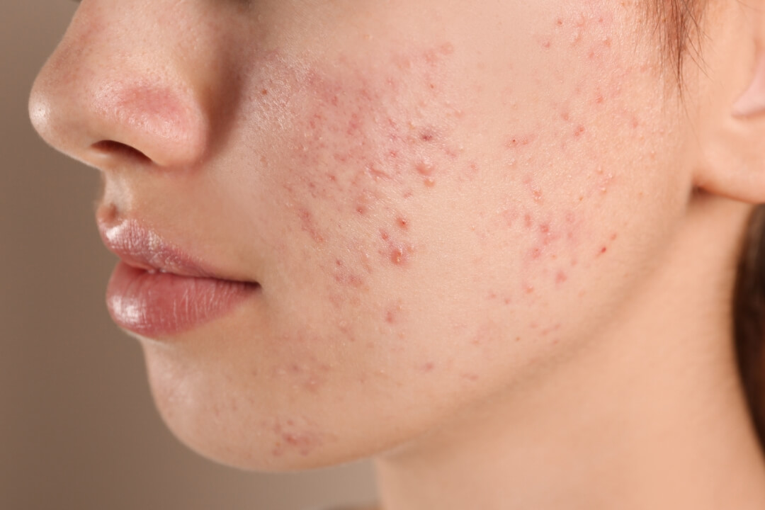 ニキビ・ニキビ跡